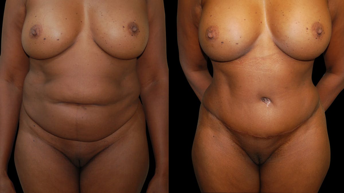 Tummy Tuck