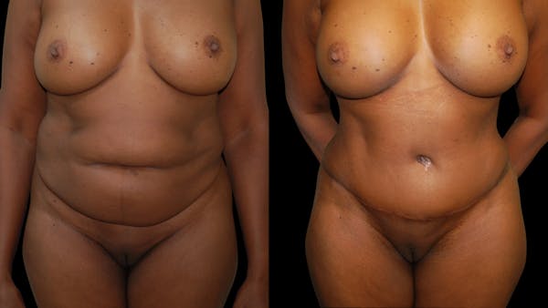 Tummy Tuck Before & After Gallery - Patient 483275 - Image 1