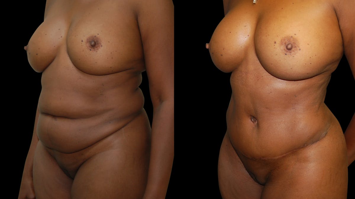 Tummy Tuck Before & After Gallery - Patient 483275 - Image 2