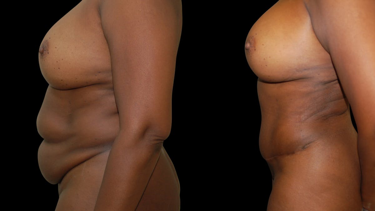 Tummy Tuck Before & After Gallery - Patient 483275 - Image 3