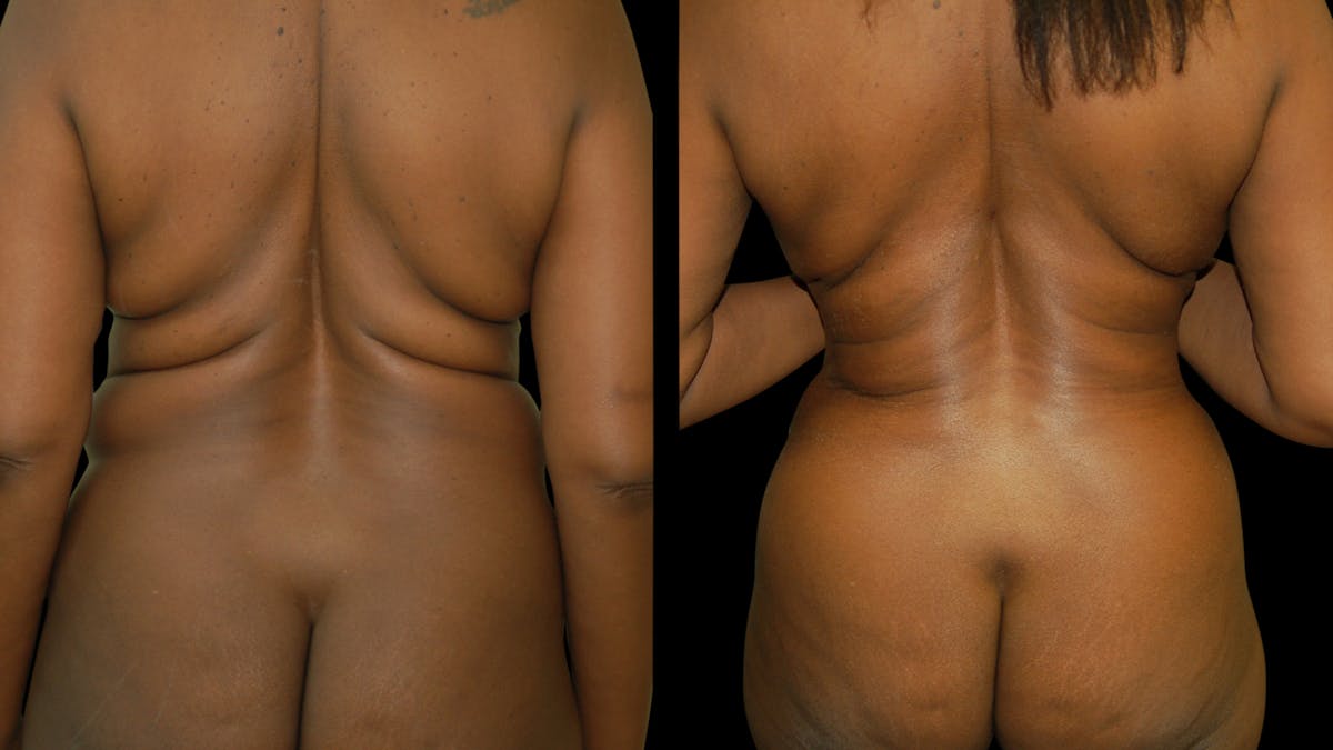 Tummy Tuck Before & After Gallery - Patient 483275 - Image 4