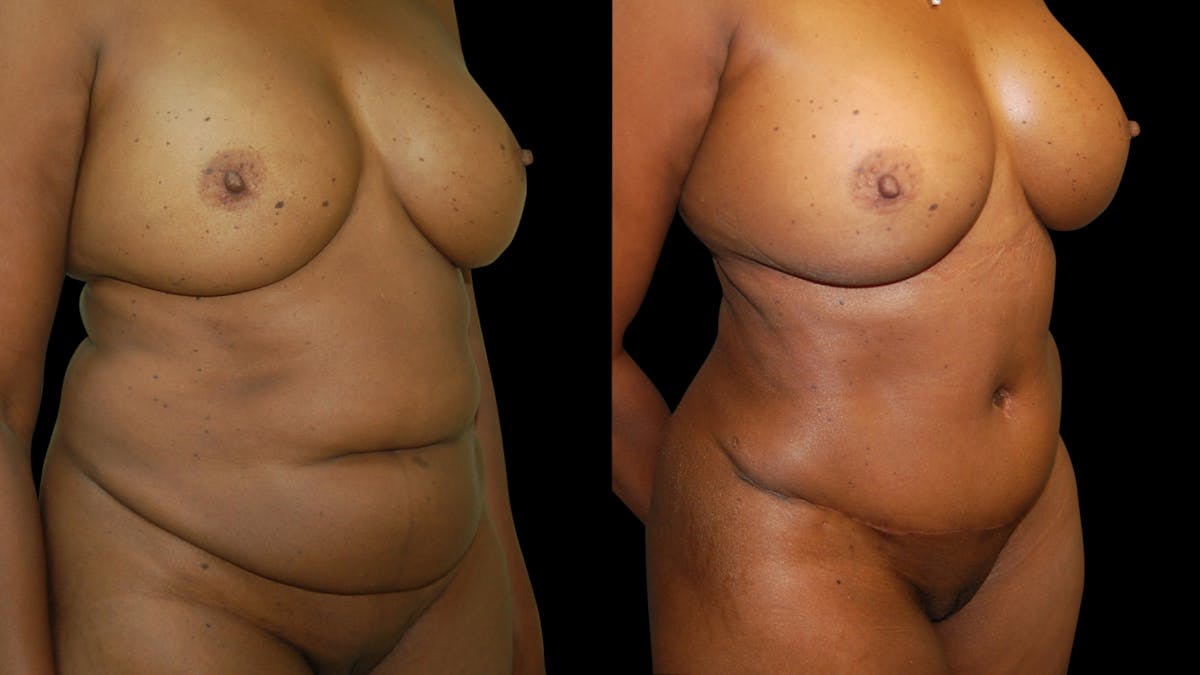 Tummy Tuck Before & After Gallery - Patient 483275 - Image 5
