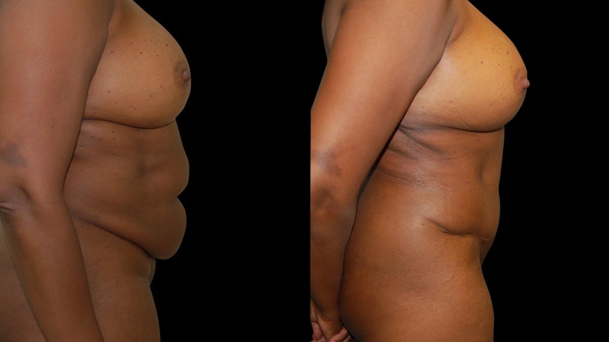 Tummy Tuck Before & After Gallery - Patient 483275 - Image 6