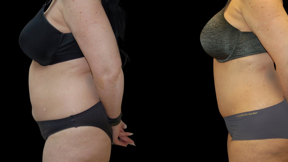 Tummy Tuck Before & After Gallery - Patient 299608 - Image 2