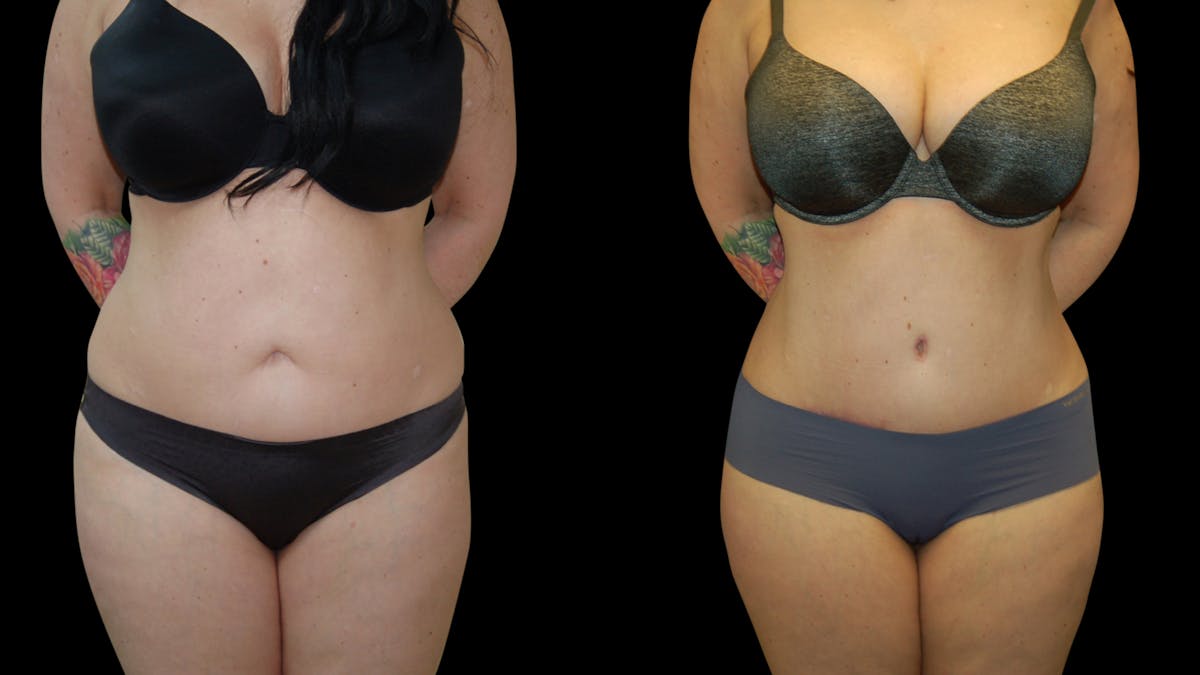 Tummy Tuck Before & After Gallery - Patient 299608 - Image 1