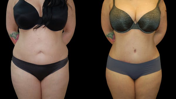 Tummy Tuck Before & After Gallery - Patient 299608 - Image 1