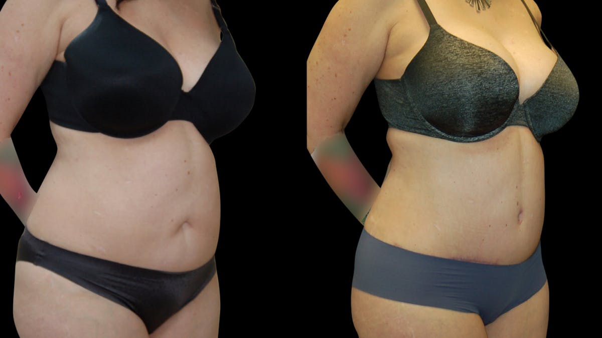 Tummy Tuck Before & After Gallery - Patient 299608 - Image 4