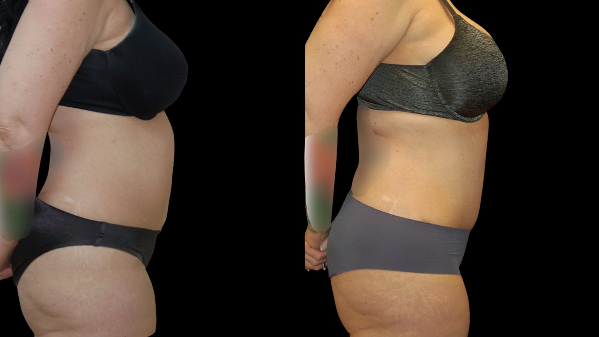 Tummy Tuck Before & After Gallery - Patient 299608 - Image 5