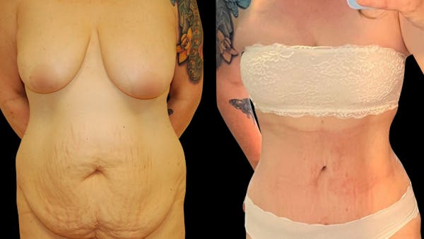 Tummy Tuck Before & After Gallery - Patient 413319 - Image 1