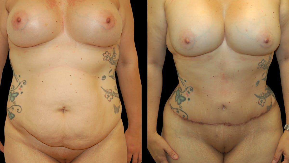 Tummy Tuck Before & After Gallery - Patient 410648 - Image 1