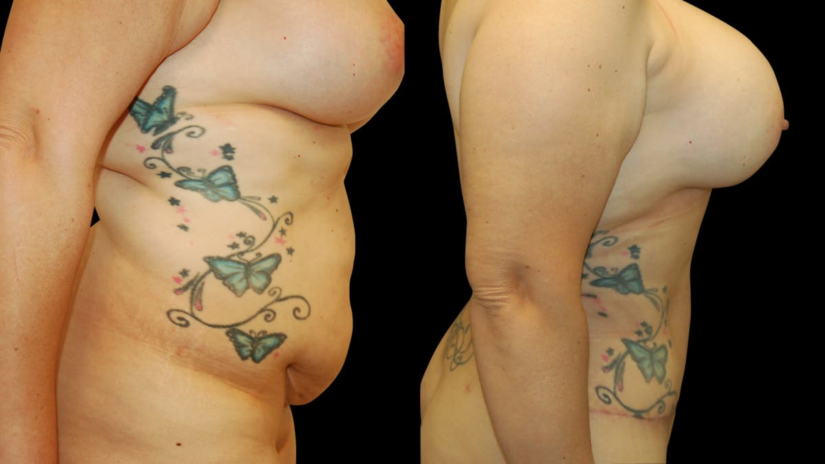 Tummy Tuck Before & After Gallery - Patient 410648 - Image 2