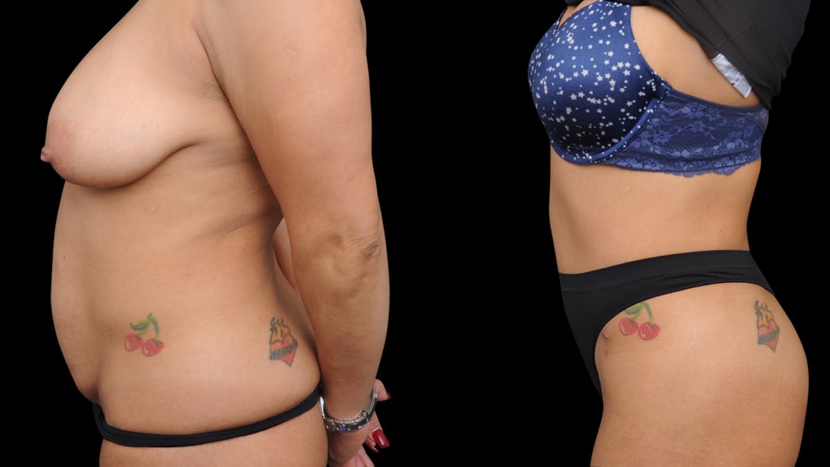 Tummy Tuck Before & After Gallery - Patient 172786 - Image 3