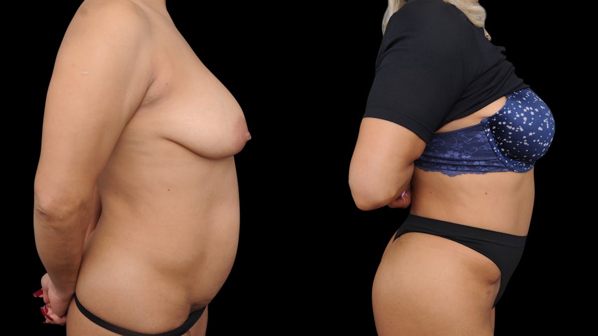Tummy Tuck Before & After Gallery - Patient 172786 - Image 5