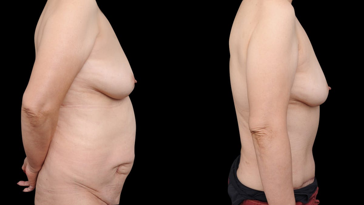 Tummy Tuck Before & After Gallery - Patient 189413 - Image 3