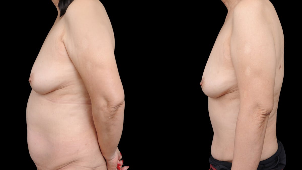Tummy Tuck Before & After Gallery - Patient 189413 - Image 5