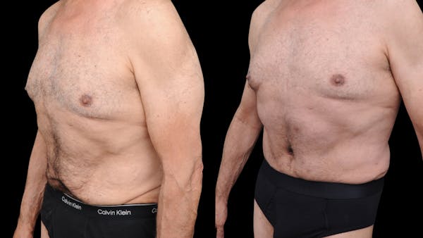 Tummy Tuck Before & After Gallery - Patient 258587 - Image 1