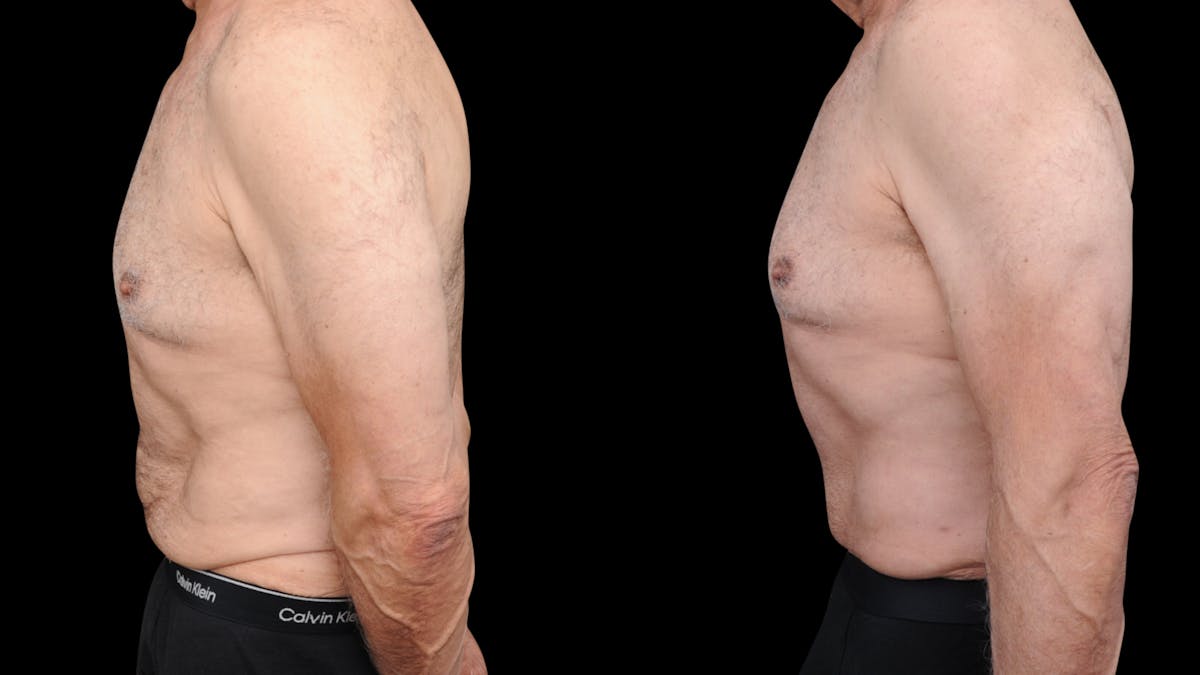 Tummy Tuck Before & After Gallery - Patient 258587 - Image 2