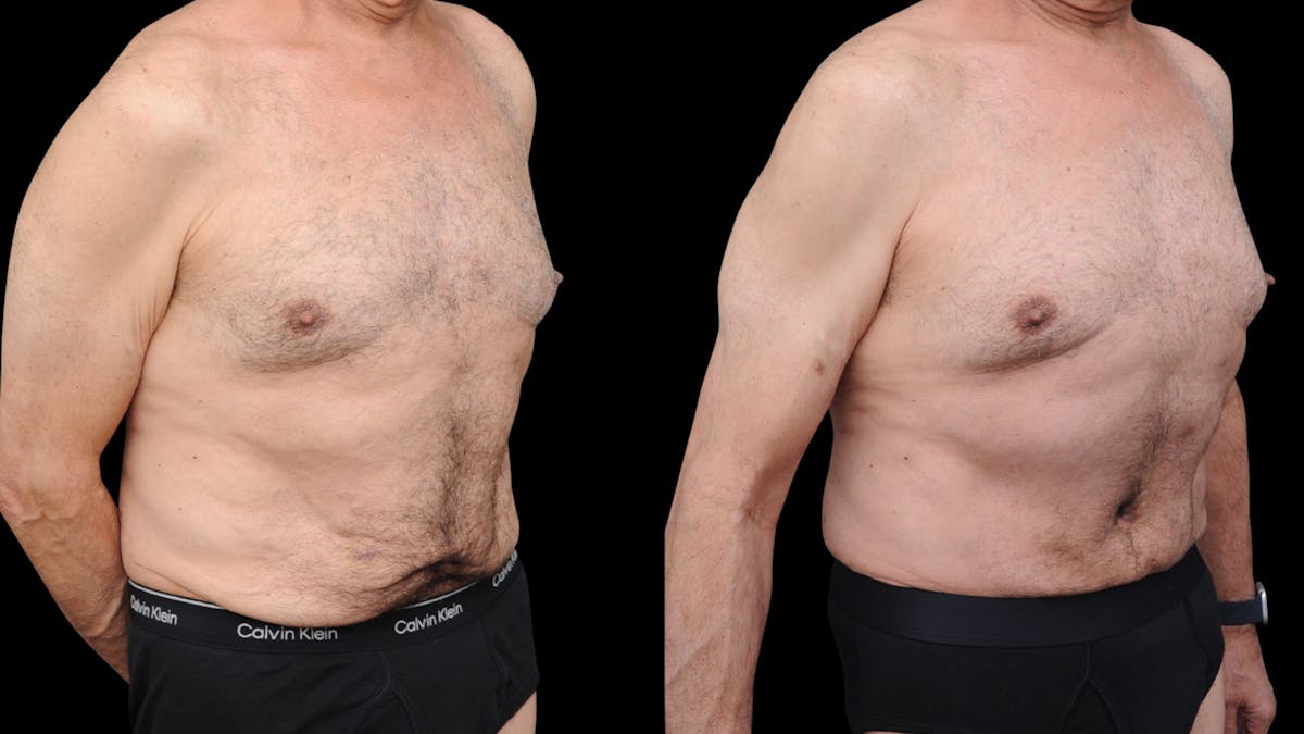 Tummy Tuck Before & After Gallery - Patient 258587 - Image 3
