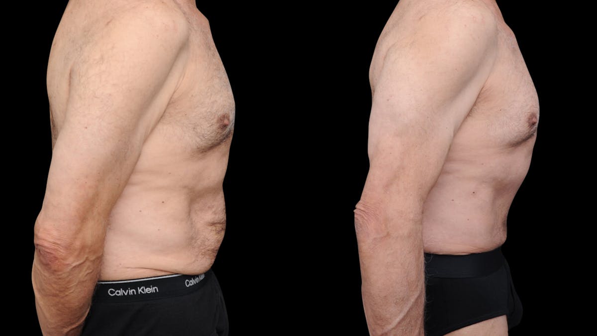 Tummy Tuck Before & After Gallery - Patient 258587 - Image 4