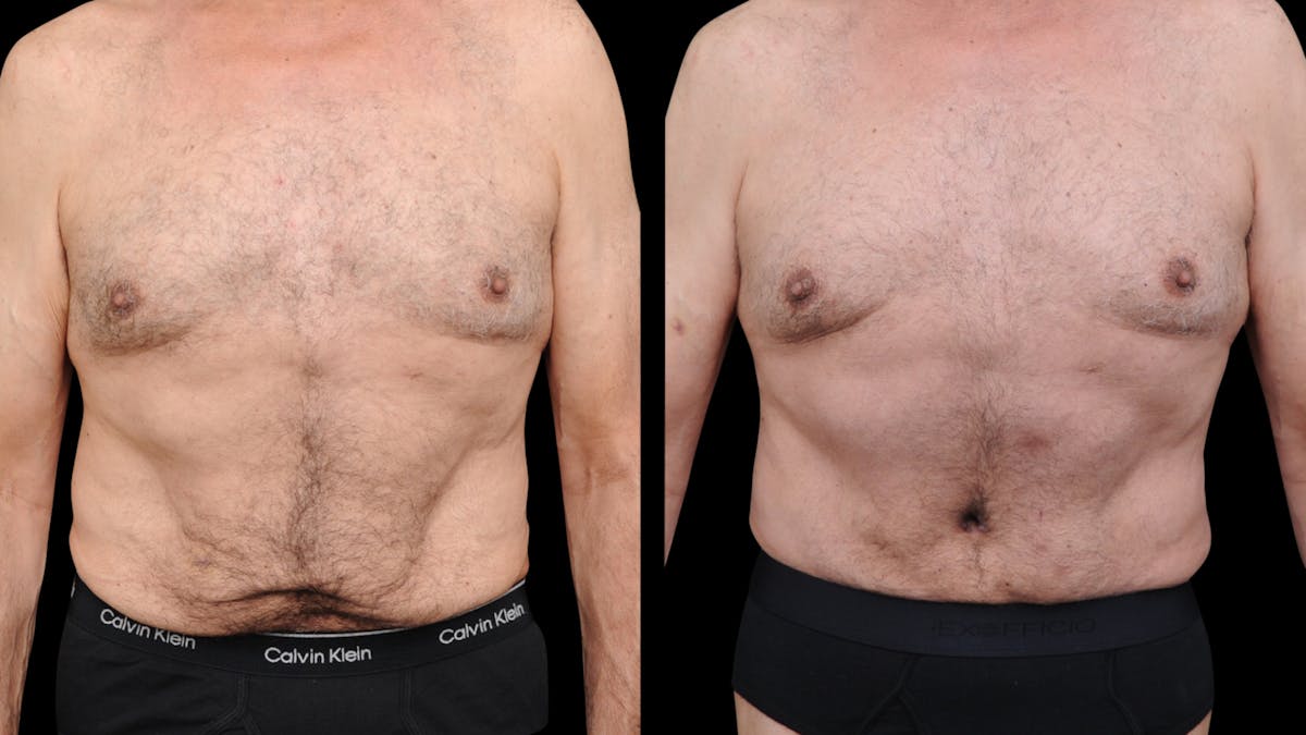Tummy Tuck Before & After Gallery - Patient 258587 - Image 5