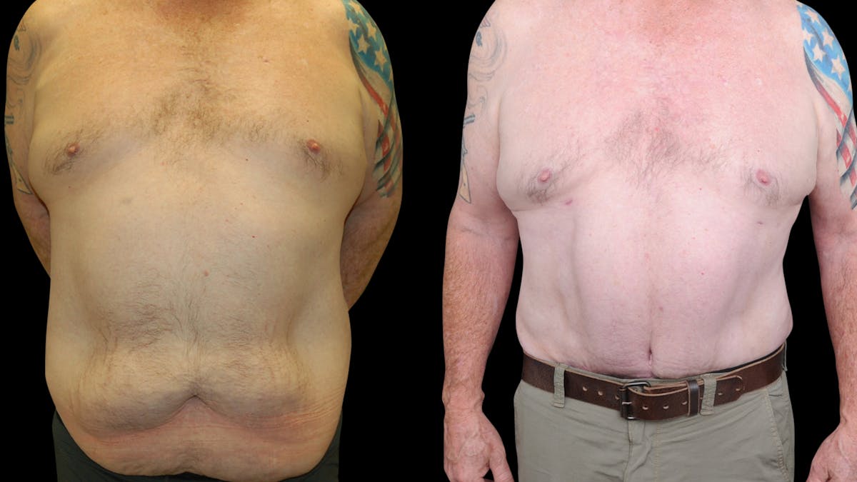 Tummy Tuck Before & After Gallery - Patient 657531 - Image 1