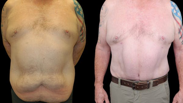 Tummy Tuck Before & After Gallery - Patient 657531 - Image 1