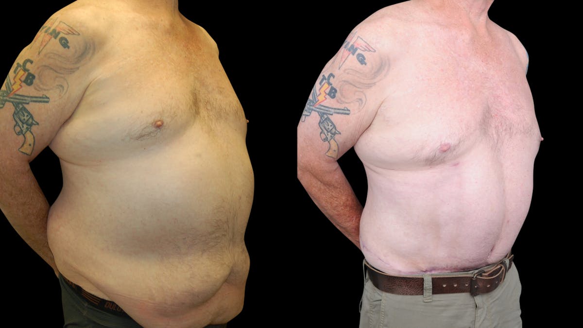 Tummy Tuck Before & After Gallery - Patient 657531 - Image 2