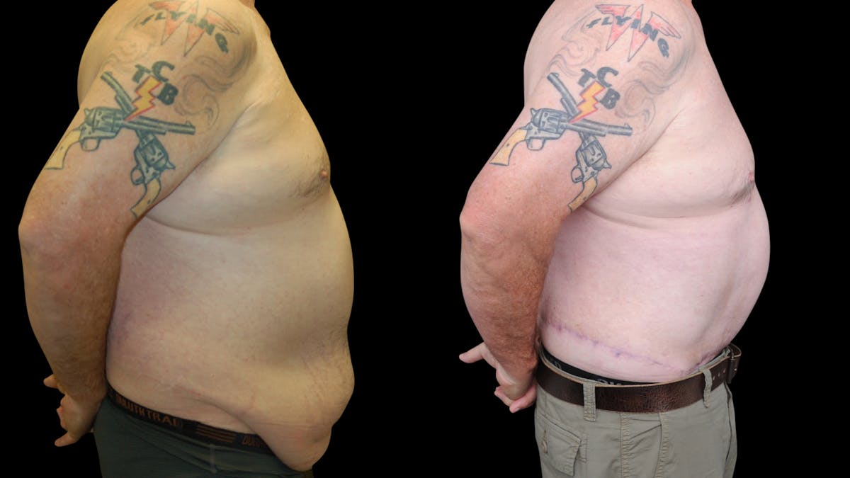 Tummy Tuck Before & After Gallery - Patient 657531 - Image 3
