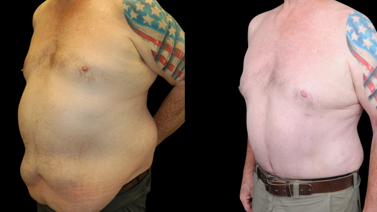 Tummy Tuck Before & After Gallery - Patient 657531 - Image 4