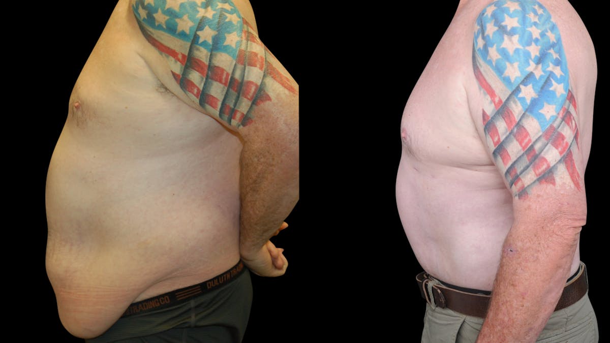 Tummy Tuck Before & After Gallery - Patient 657531 - Image 5