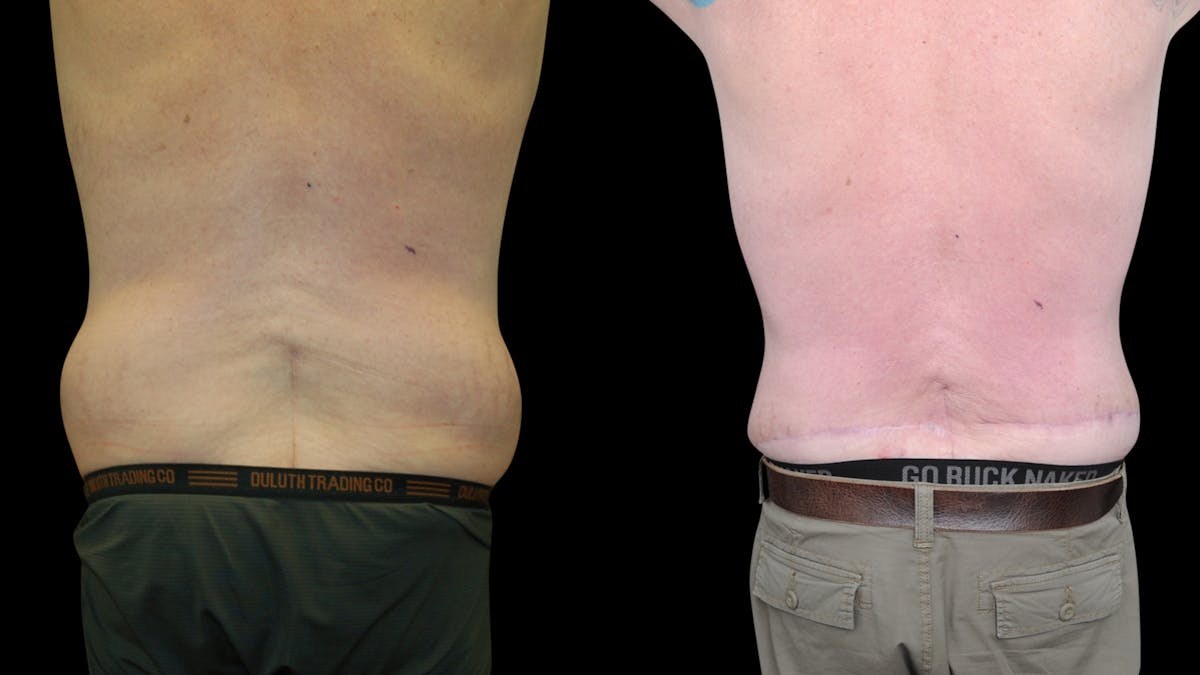 Tummy Tuck Before & After Gallery - Patient 657531 - Image 6