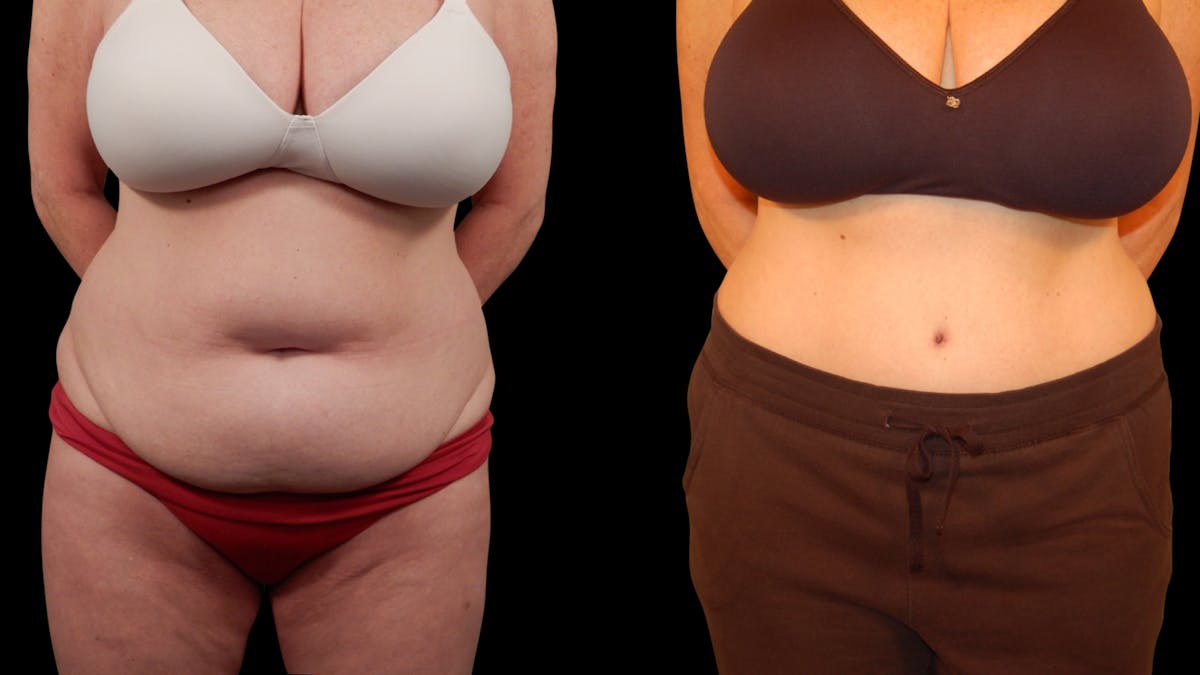 Tummy Tuck Before & After Gallery - Patient 105465 - Image 1