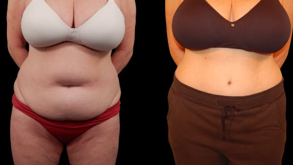 Tummy Tuck Before & After Gallery - Patient 105465 - Image 1