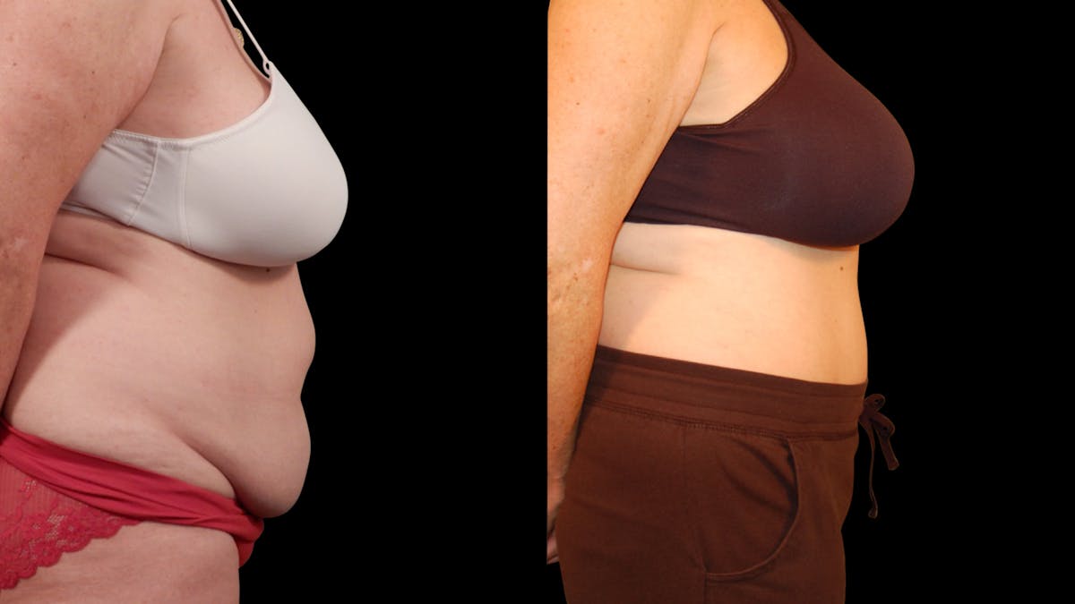 Tummy Tuck Before & After Gallery - Patient 105465 - Image 2
