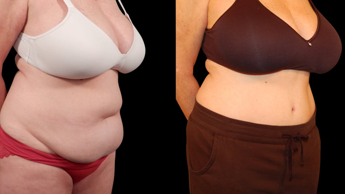Tummy Tuck Before & After Gallery - Patient 105465 - Image 3
