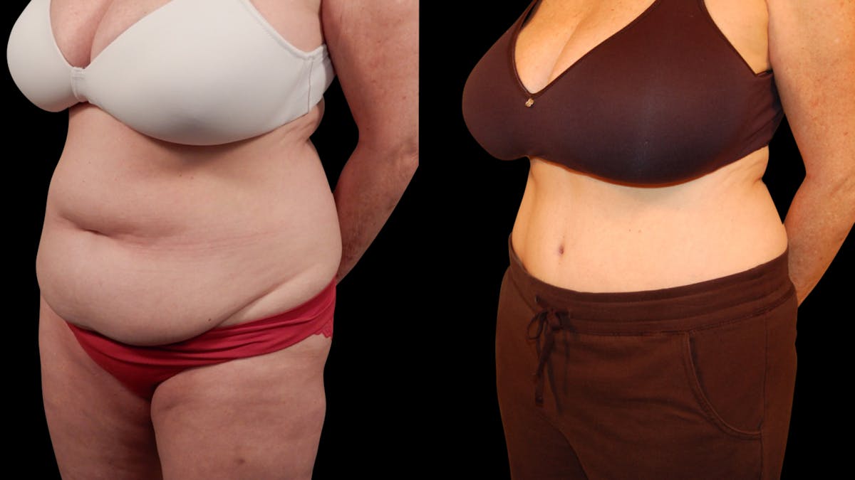 Tummy Tuck Before & After Gallery - Patient 105465 - Image 4