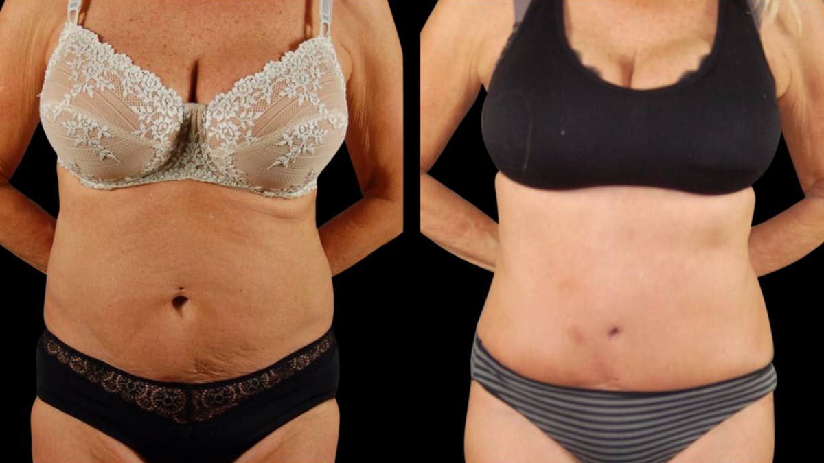 Tummy Tuck Before & After Gallery - Patient 293715 - Image 1