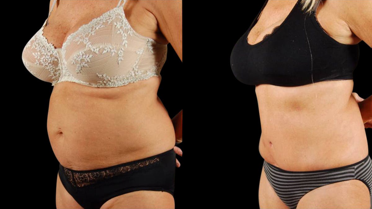 Tummy Tuck Before & After Gallery - Patient 293715 - Image 2