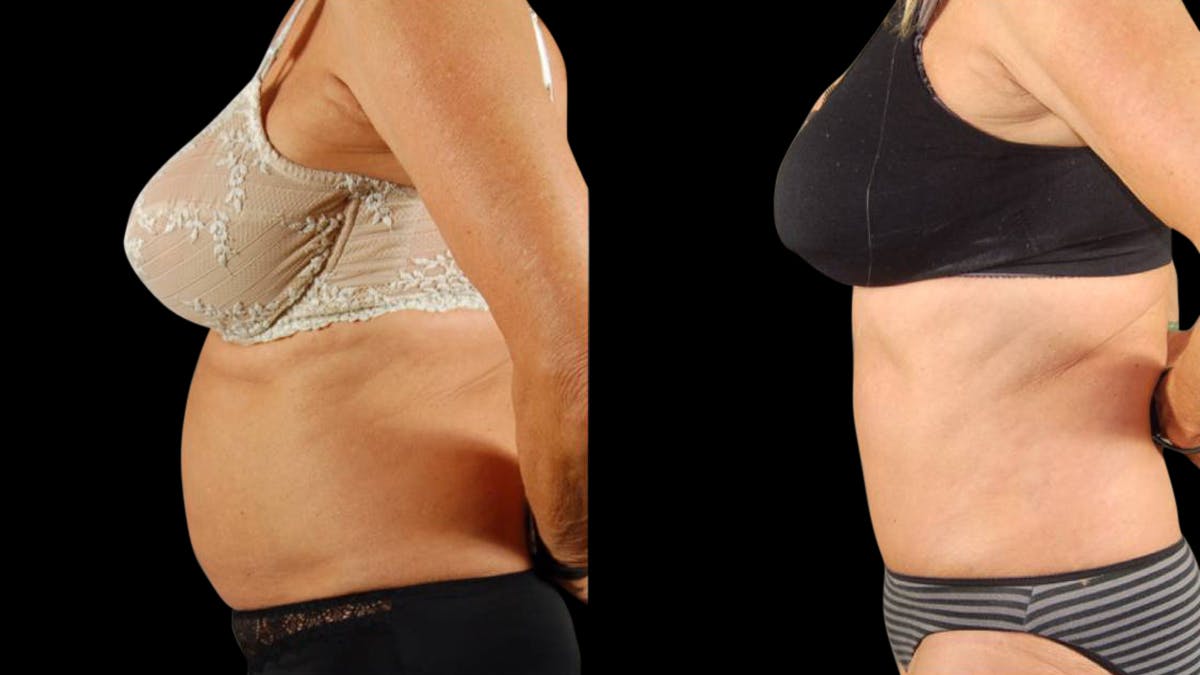Tummy Tuck Before & After Gallery - Patient 293715 - Image 3