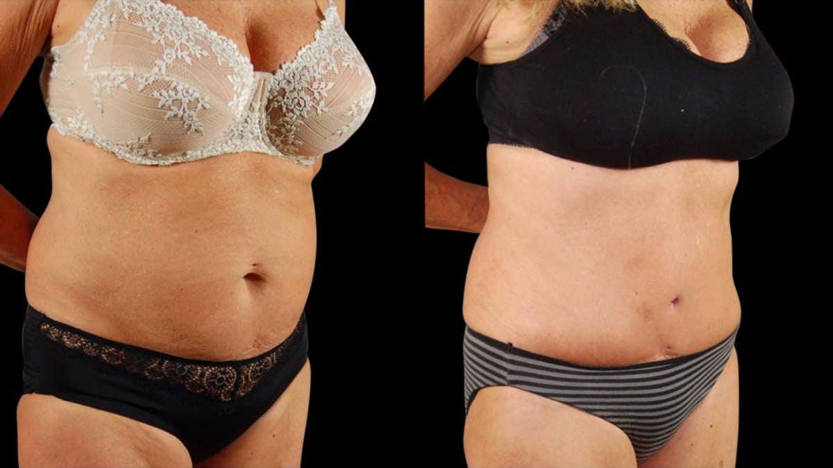 Tummy Tuck Before & After Gallery - Patient 293715 - Image 4