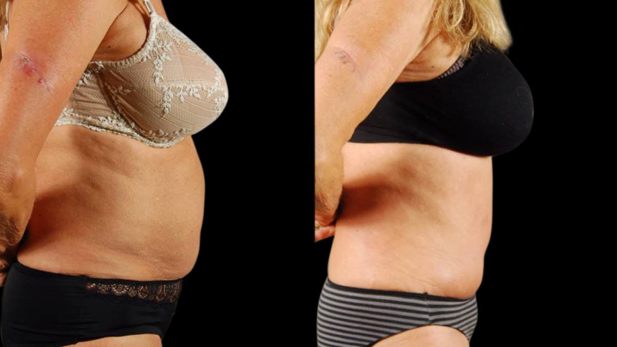 Tummy Tuck Before & After Gallery - Patient 293715 - Image 5