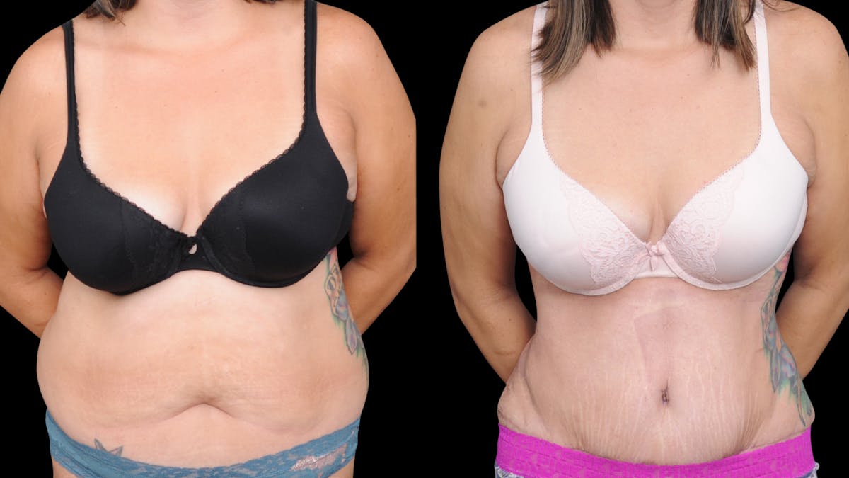 Tummy Tuck Before & After Gallery - Patient 107412 - Image 1