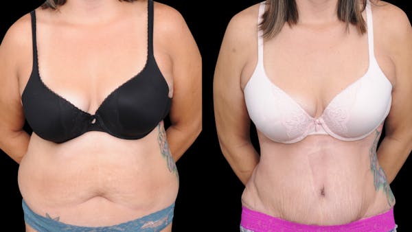 Tummy Tuck Before & After Gallery - Patient 107412 - Image 1