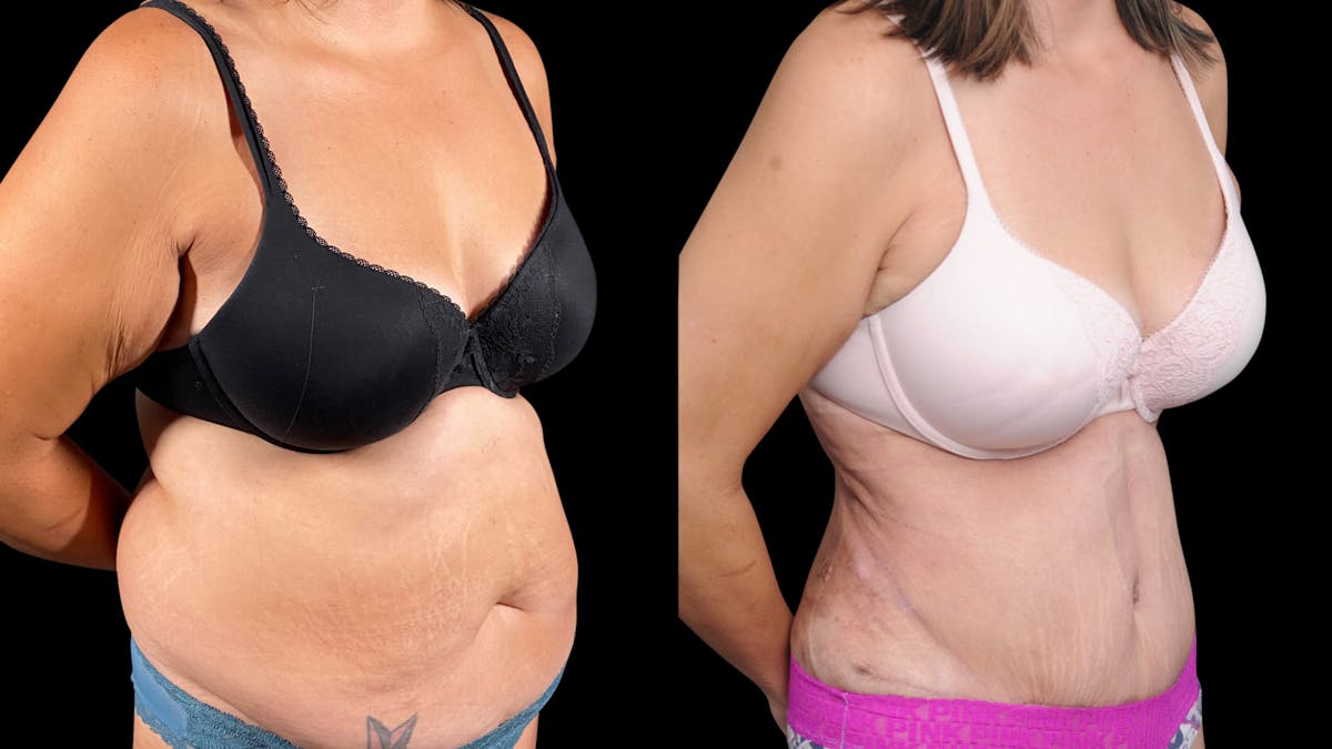 Tummy Tuck Before & After Gallery - Patient 107412 - Image 2