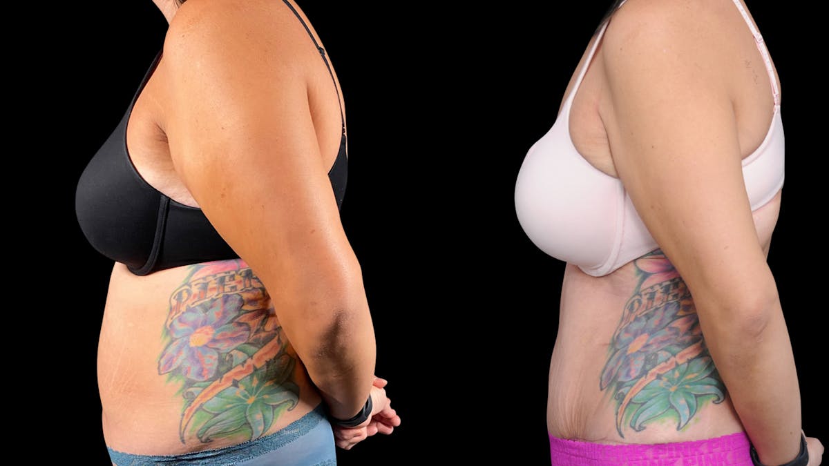 Tummy Tuck Before & After Gallery - Patient 107412 - Image 3