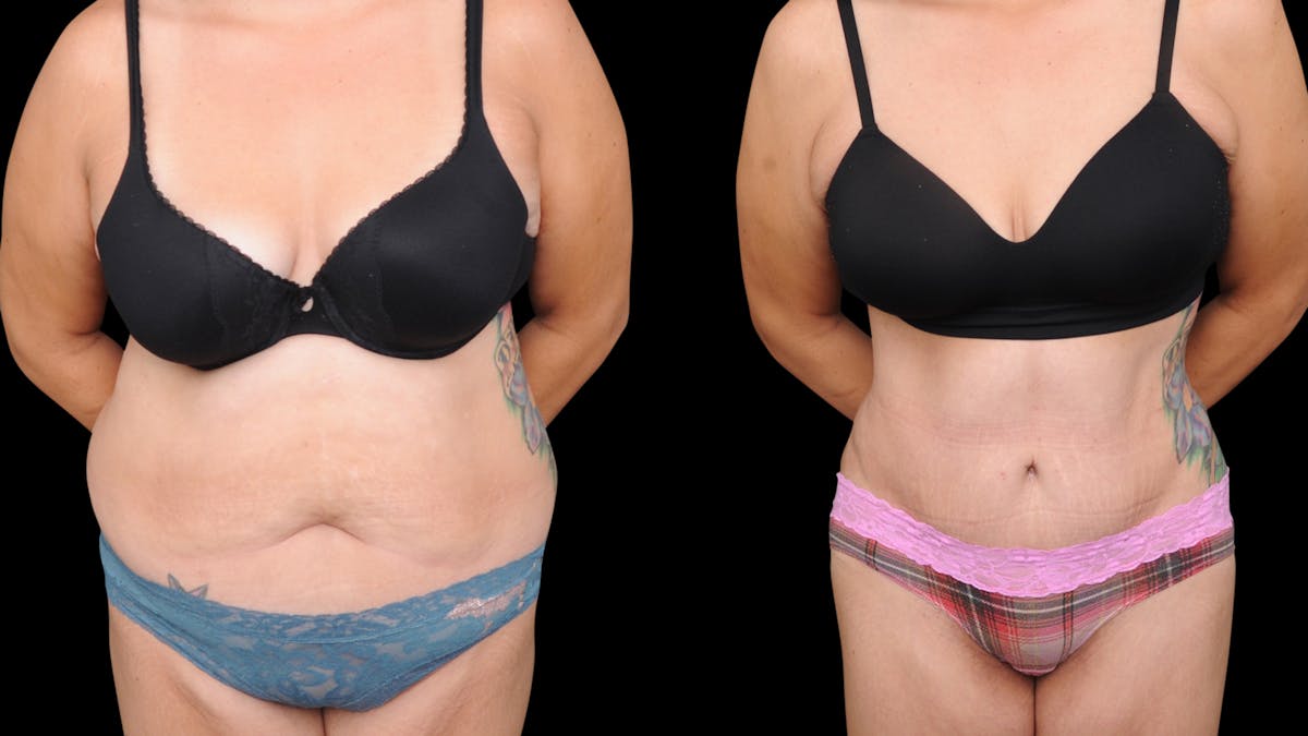 Tummy Tuck Before & After Gallery - Patient 107412 - Image 4