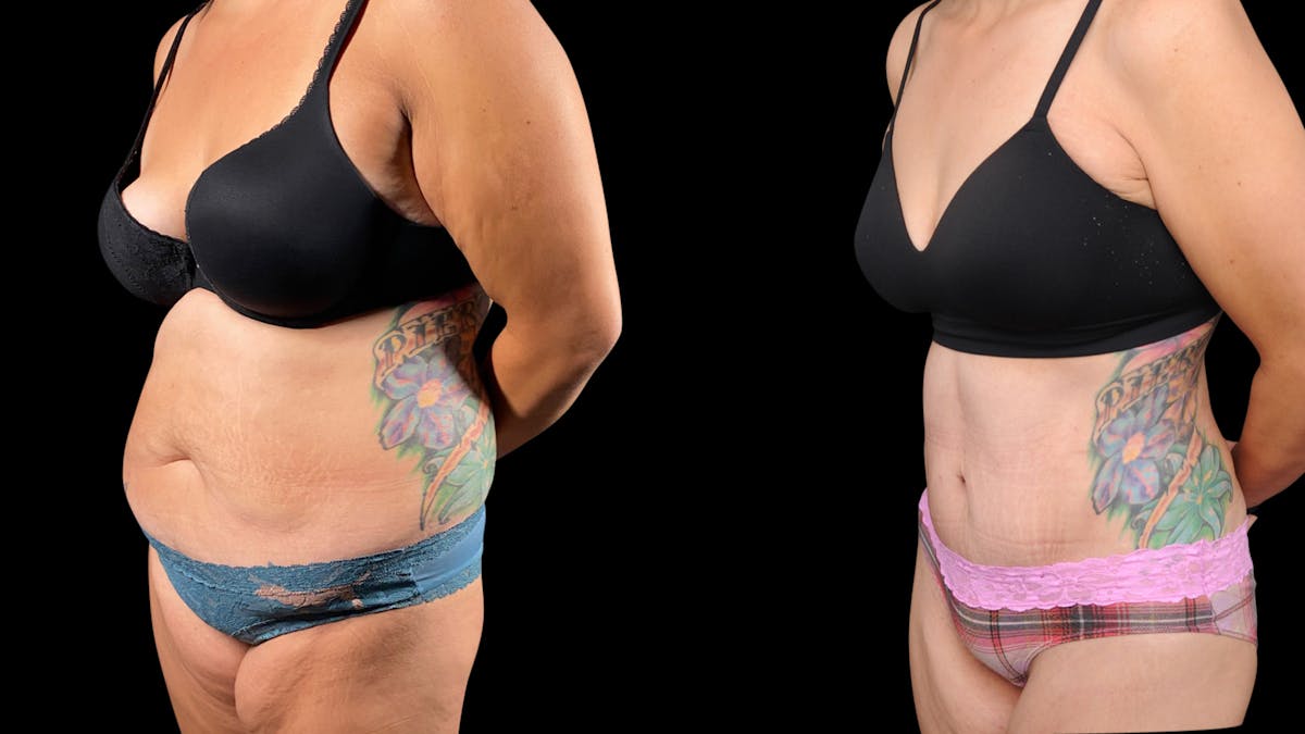 Tummy Tuck Before & After Gallery - Patient 107412 - Image 5