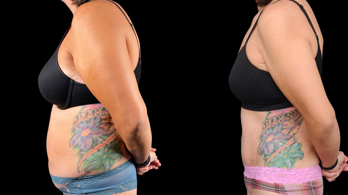 Tummy Tuck Before & After Gallery - Patient 107412 - Image 6