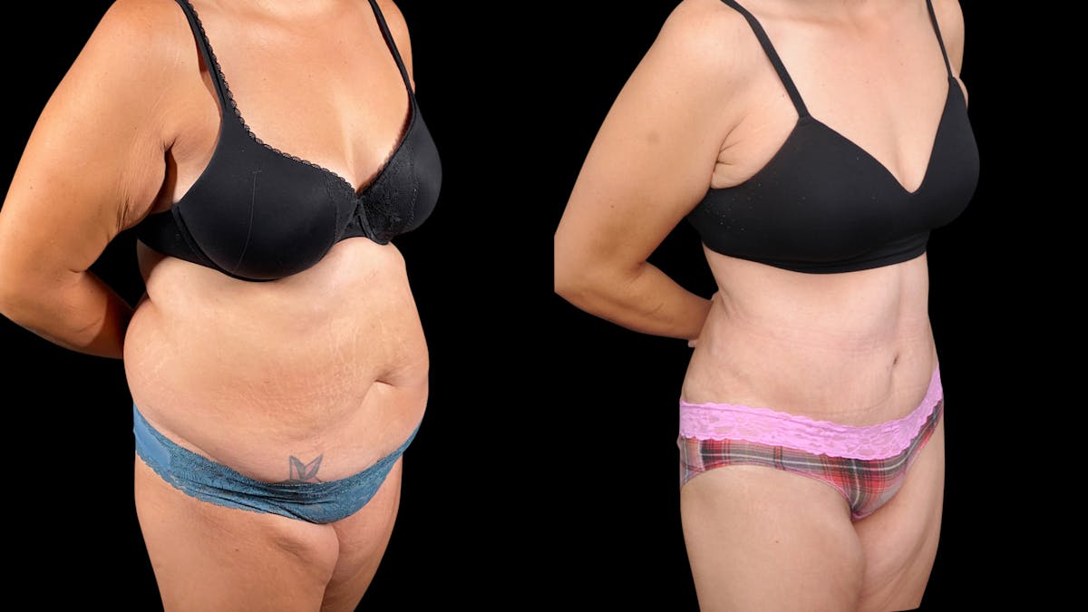 Tummy Tuck Before & After Gallery - Patient 107412 - Image 7