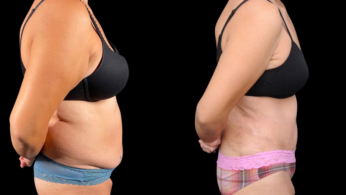 Tummy Tuck Before & After Gallery - Patient 107412 - Image 8